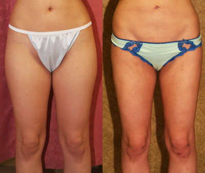 Liposuction Thighs Before & After Patient #9455