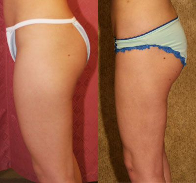 Liposuction Thighs Before & After Patient #9455