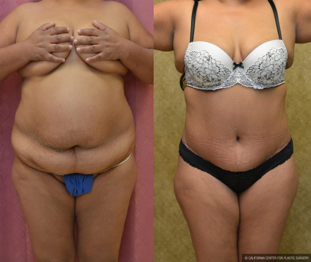 Tummy Tuck (Abdominoplasty) Plus Size Before & After Patient #9798