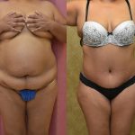 Tummy Tuck (Abdominoplasty) Plus Size Before & After Patient #9798