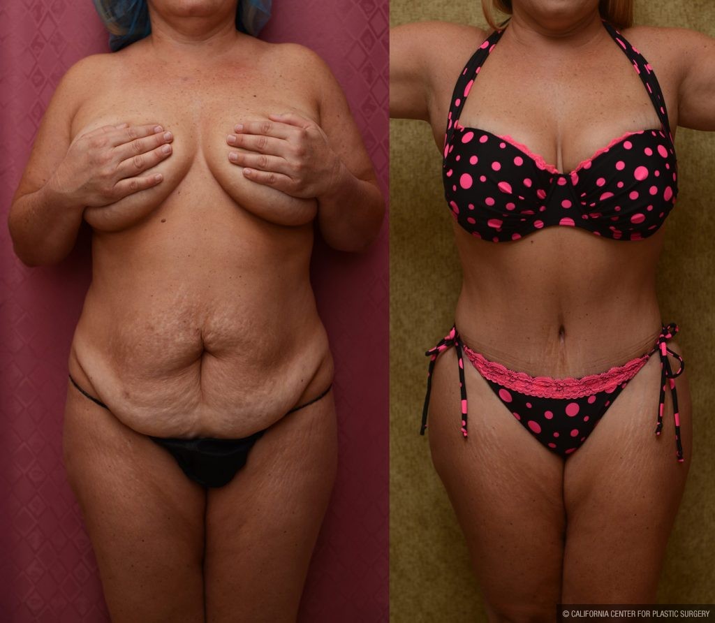 Tummy Tuck (Abdominoplasty) Medium Size Before & After Patient #9777