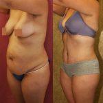 Tummy Tuck (Abdominoplasty) Medium Size Before & After Patient #9771