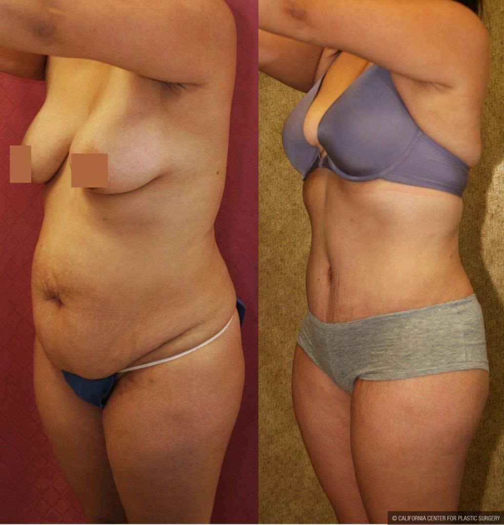 Tummy Tuck (Abdominoplasty) Medium Size Before & After Patient #9771