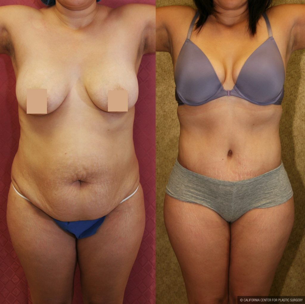 Tummy Tuck (Abdominoplasty) Medium Size Before & After Patient #9771