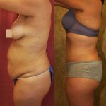 Tummy Tuck (Abdominoplasty) Medium Size Before & After Patient #9771