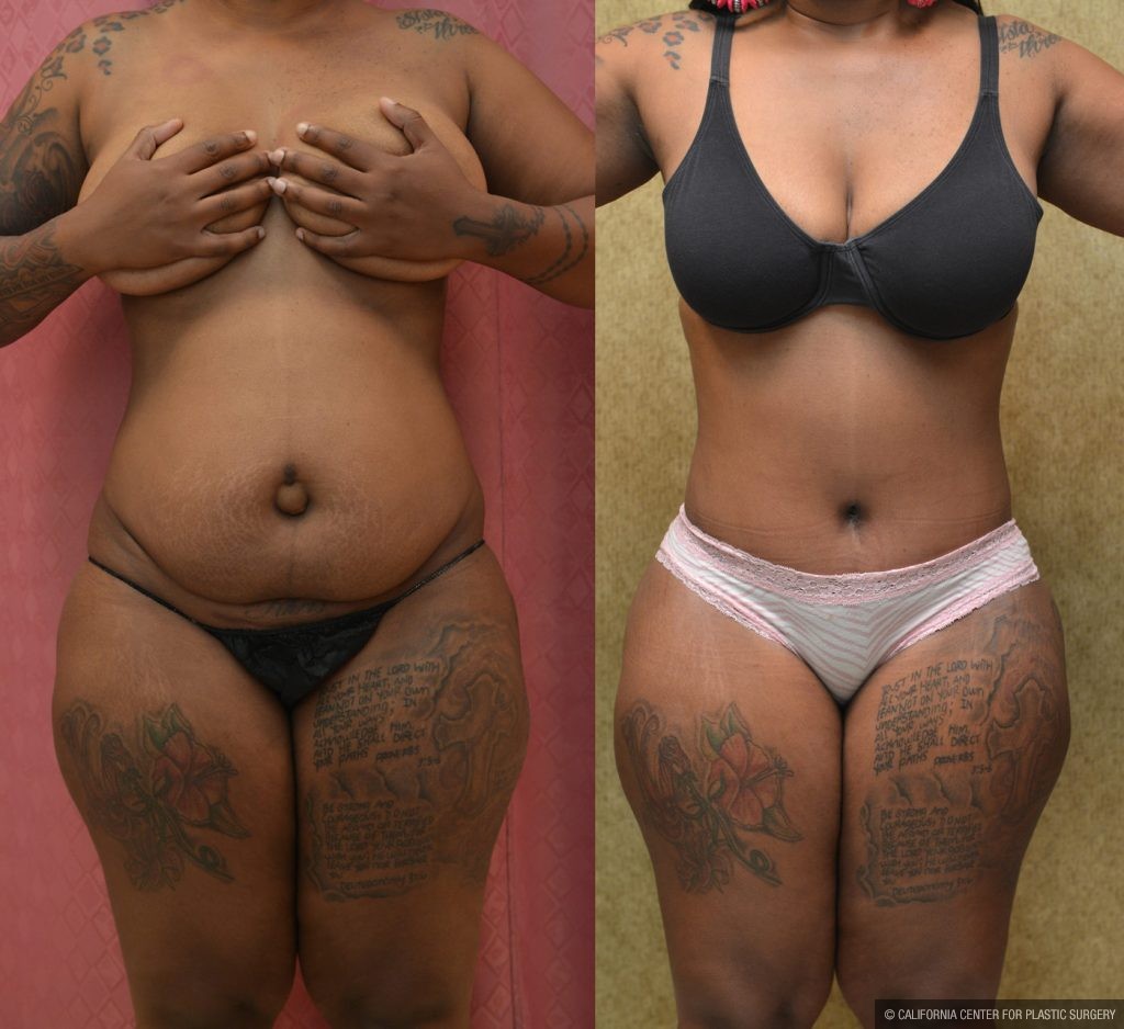 African American Tummy Tuck (Abdominoplasty) Before & After Patient #9787