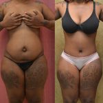 African American Tummy Tuck (Abdominoplasty) Before & After Patient #9787