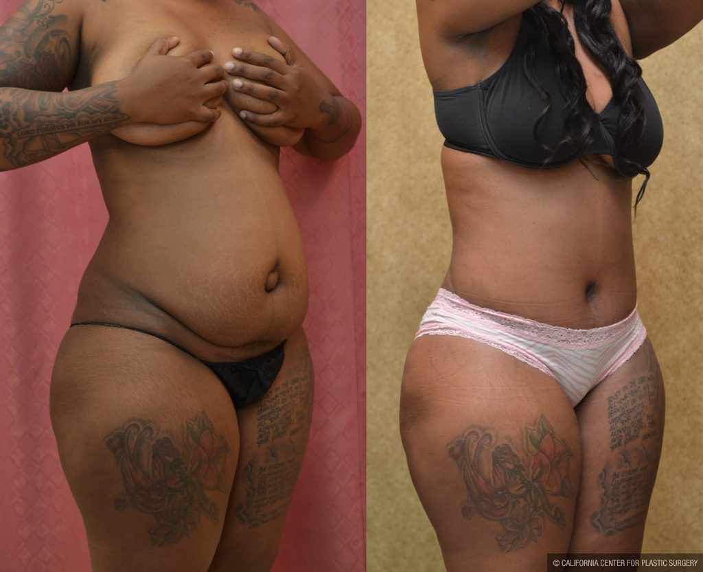 African American Tummy Tuck (Abdominoplasty) Before & After Patient #9787