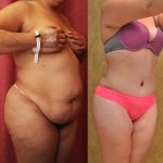 Tummy Tuck (Abdominoplasty) Plus Size Before & After Patient #9794