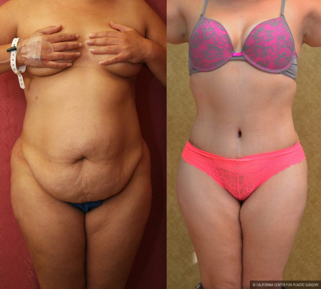 Tummy Tuck (Abdominoplasty) Plus Size Before & After Patient #9794