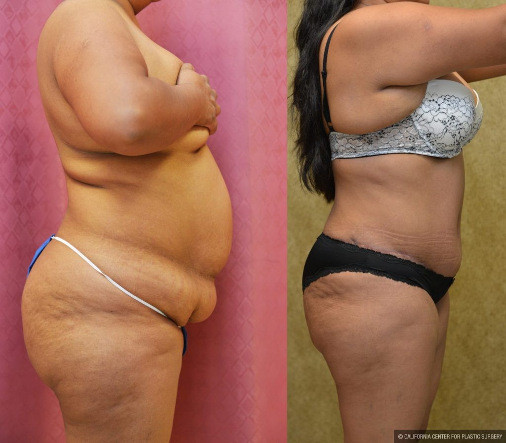 Patient #9798 Tummy Tuck (Abdominoplasty) Plus Size Before and