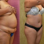 Tummy Tuck (Abdominoplasty) Plus Size Before & After Patient #9798