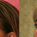 Eyelid (Blepharoplasty) Before & After Patient #9898