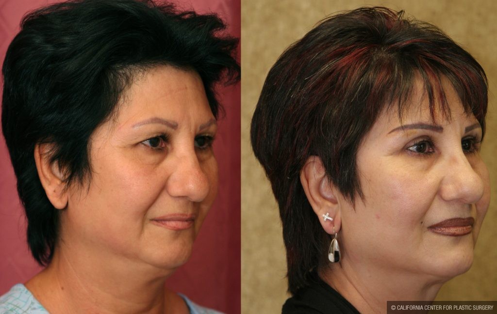 Eyelid (Blepharoplasty) Before & After Patient #9913