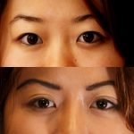 Asian Eyelid Surgery (Blepharoplasty) Before & After Patient #9883