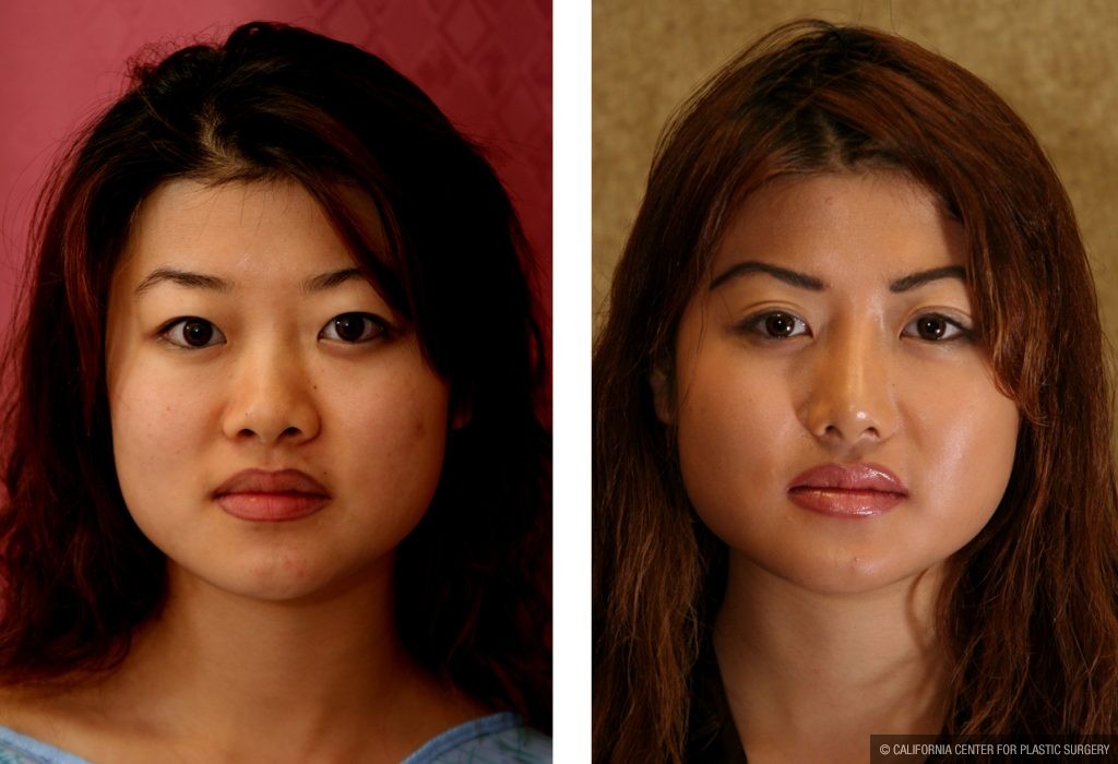 Asian Eyelid Surgery (Blepharoplasty) Before & After Patient #9883