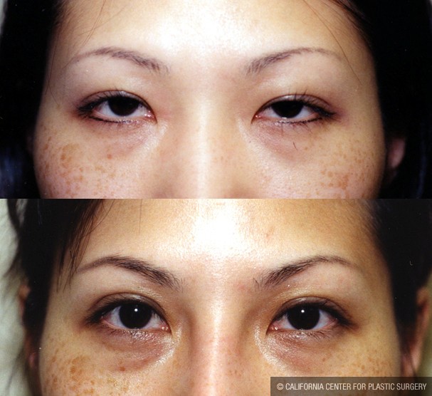 Asian Eyelid Surgery (Blepharoplasty) Before & After Patient #9886