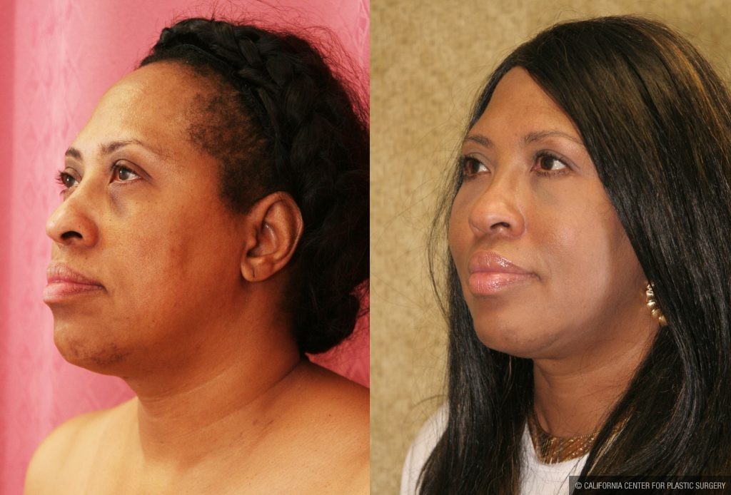 Eyelid (Blepharoplasty) Before & After Patient #9908