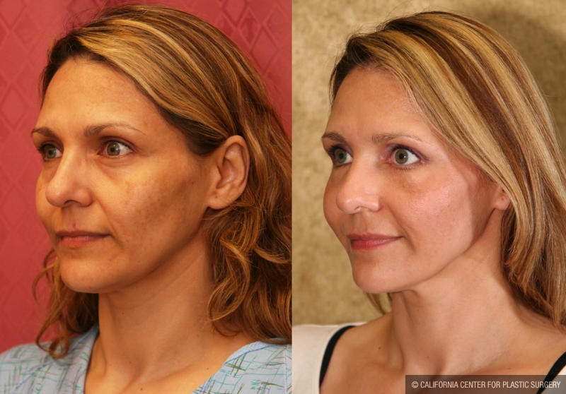 Eyelid (Blepharoplasty) Before & After Patient #9859