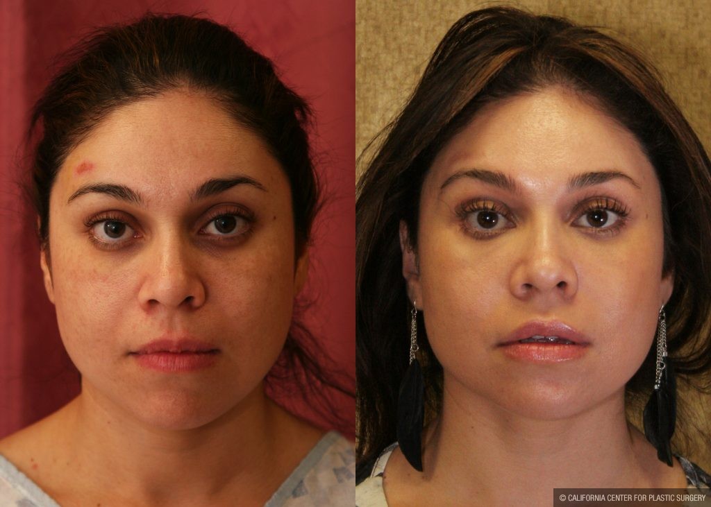 Eyelid (Blepharoplasty) Before & After Patient #9865