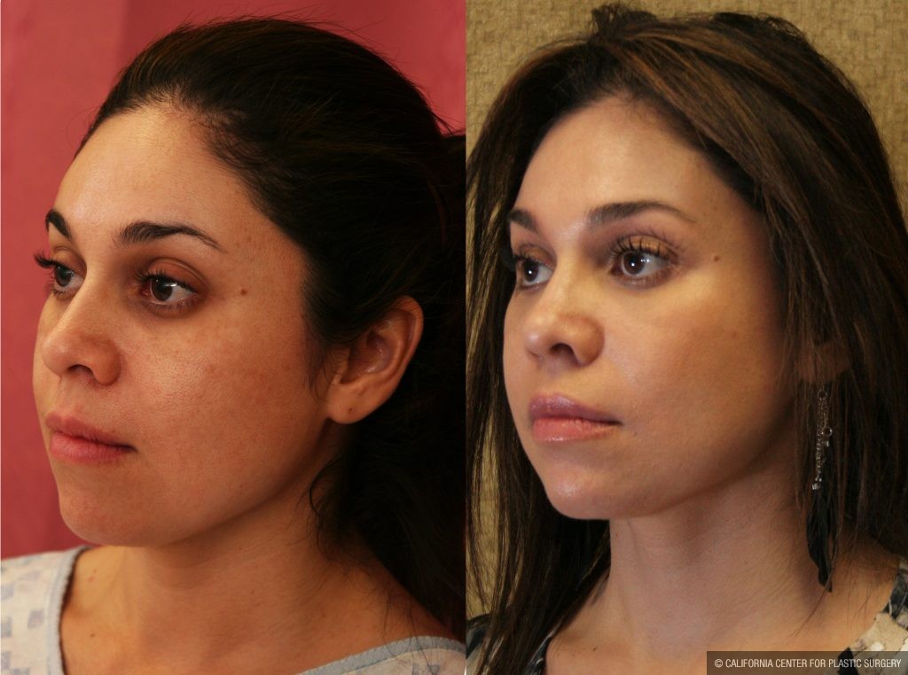 Eyelid (Blepharoplasty) Before & After Patient #9865