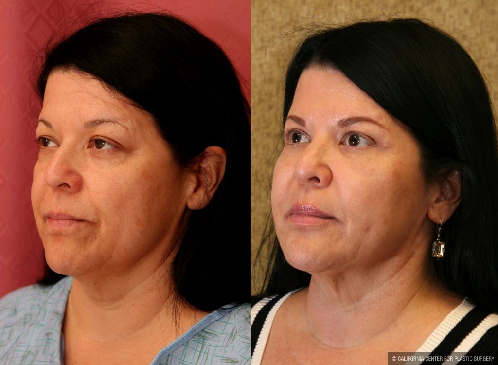 Eyelid (Blepharoplasty) Before & After Patient #9902