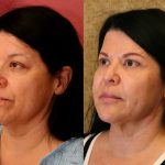 Eyelid (Blepharoplasty) Before & After Patient #9902