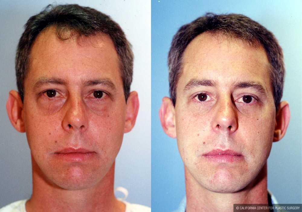 Eyelid (Blepharoplasty) Before & After Patient #9927