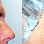 Eyelid (Blepharoplasty) Before & After Patient #9927