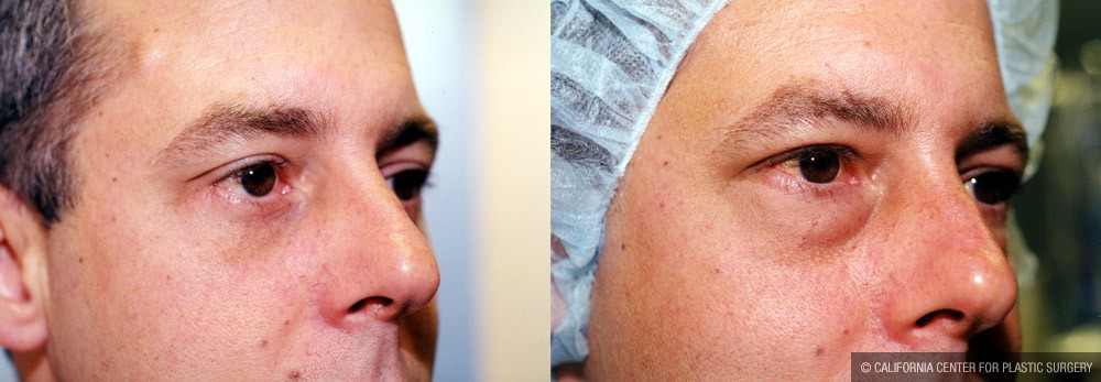 Eyelid (Blepharoplasty) Before & After Patient #9927