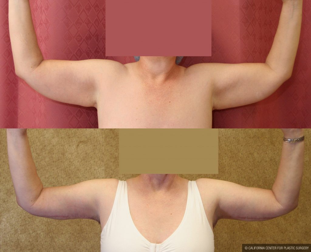 Arm Lift (Brachioplasty) Before & After Patient #9961