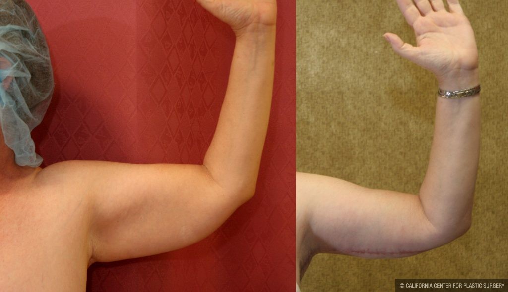 Arm Lift (Brachioplasty) Before & After Patient #9961