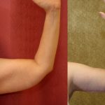 Arm Lift (Brachioplasty) Before & After Patient #9961