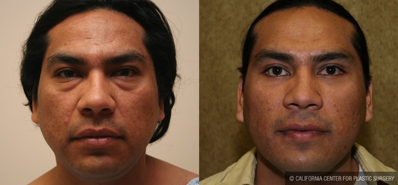 Eyelid (Blepharoplasty) Before & After Patient #9918