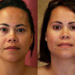 Asian Eyelid Surgery (Blepharoplasty) Before & After Patient #9923