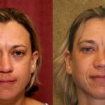 Eyelid (Blepharoplasty) Before & After Patient #9932