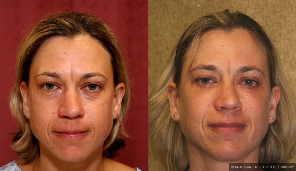 Eyelid (Blepharoplasty) Before & After Patient #9932