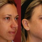 Eyelid (Blepharoplasty) Before & After Patient #9932