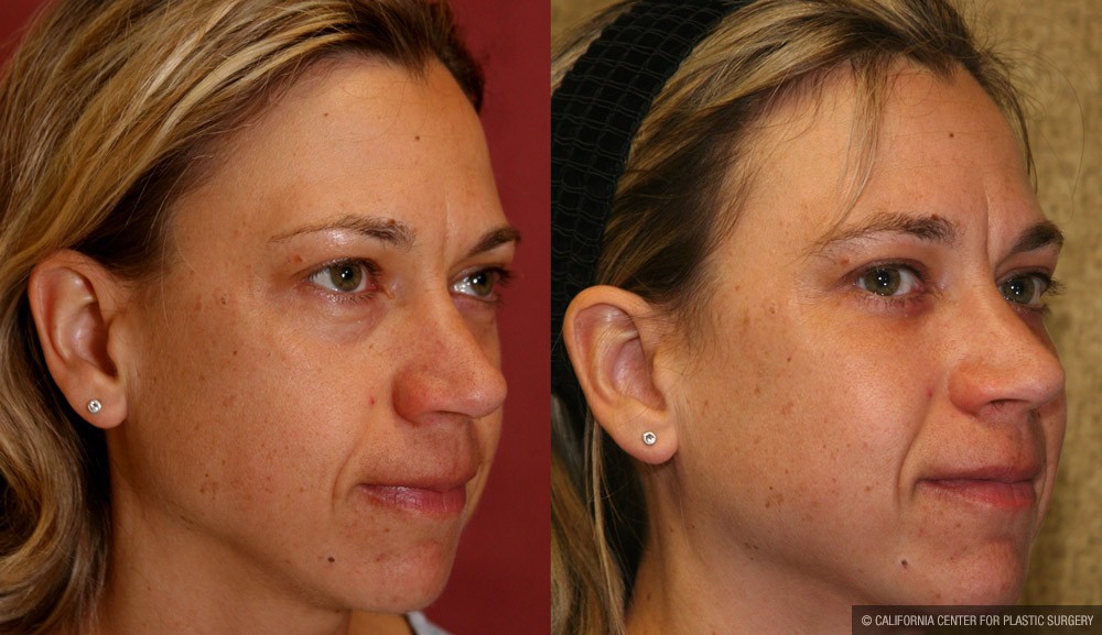 Eyelid (Blepharoplasty) Before & After Patient #9932