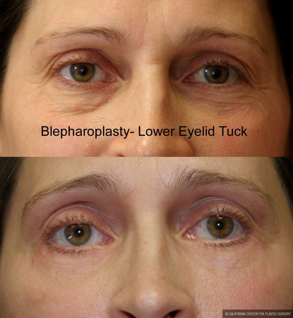 Eyelid (Blepharoplasty) Before & After Patient #9871