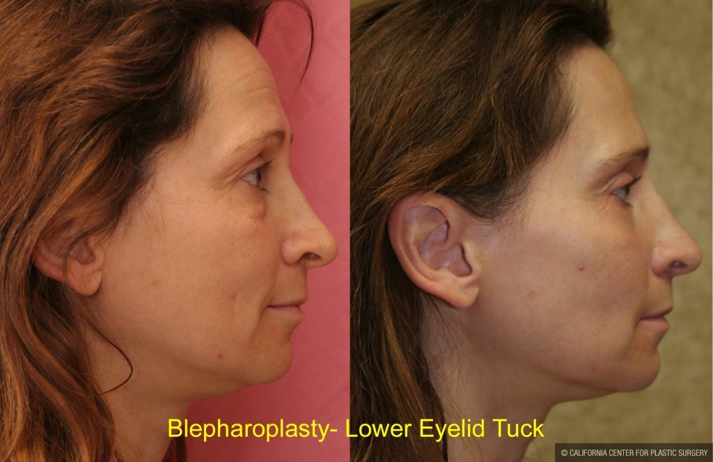 Eyelid (Blepharoplasty) Before & After Patient #9871