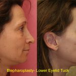 Eyelid (Blepharoplasty) Before & After Patient #9871