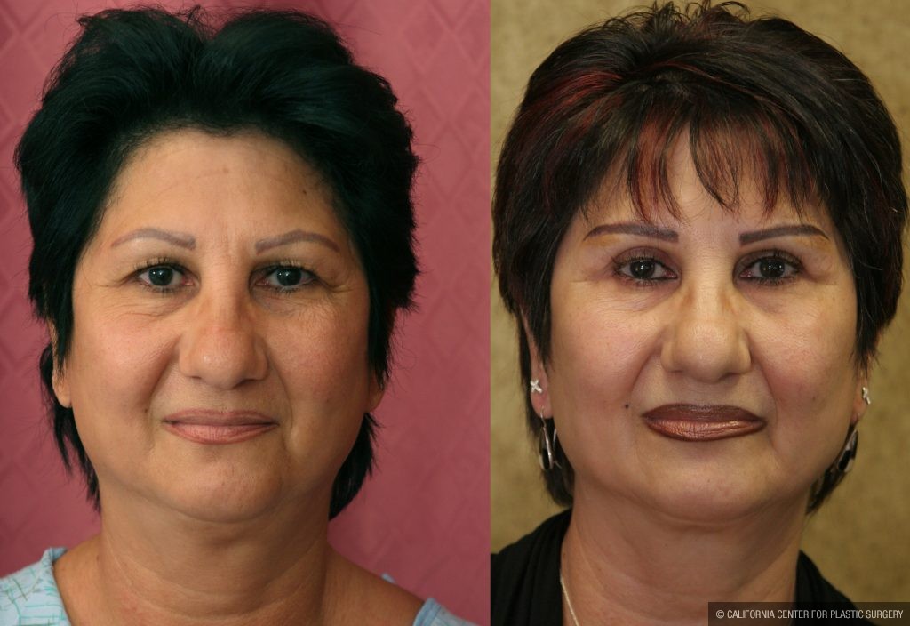 Eyelid (Blepharoplasty) Before & After Patient #9913