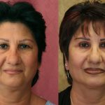 Eyelid (Blepharoplasty) Before & After Patient #9913