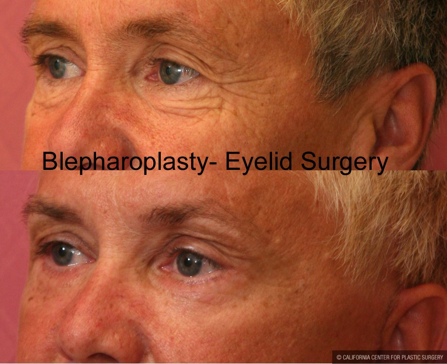 Eyelid (Blepharoplasty) Before & After Patient #9876