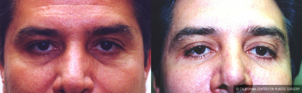Eyelid (Blepharoplasty) Before & After Patient #9942