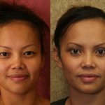 Asian Eyelid Surgery (Blepharoplasty) Before & After Patient #9891