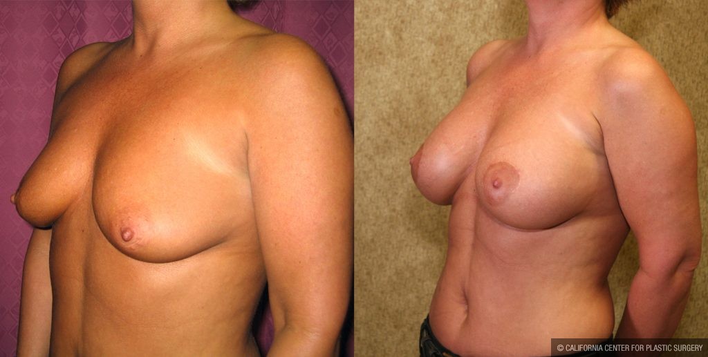 Breast Augmentation Before & After Patient #10429