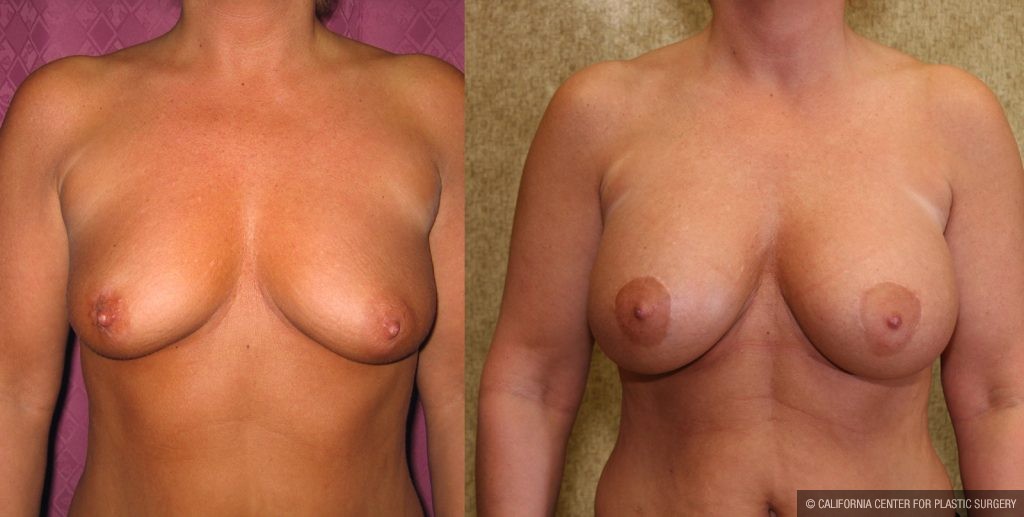 Breast Augmentation Before & After Patient #10429