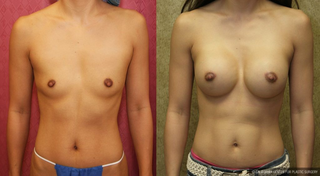 Breast Augmentation Before & After Patient #10432